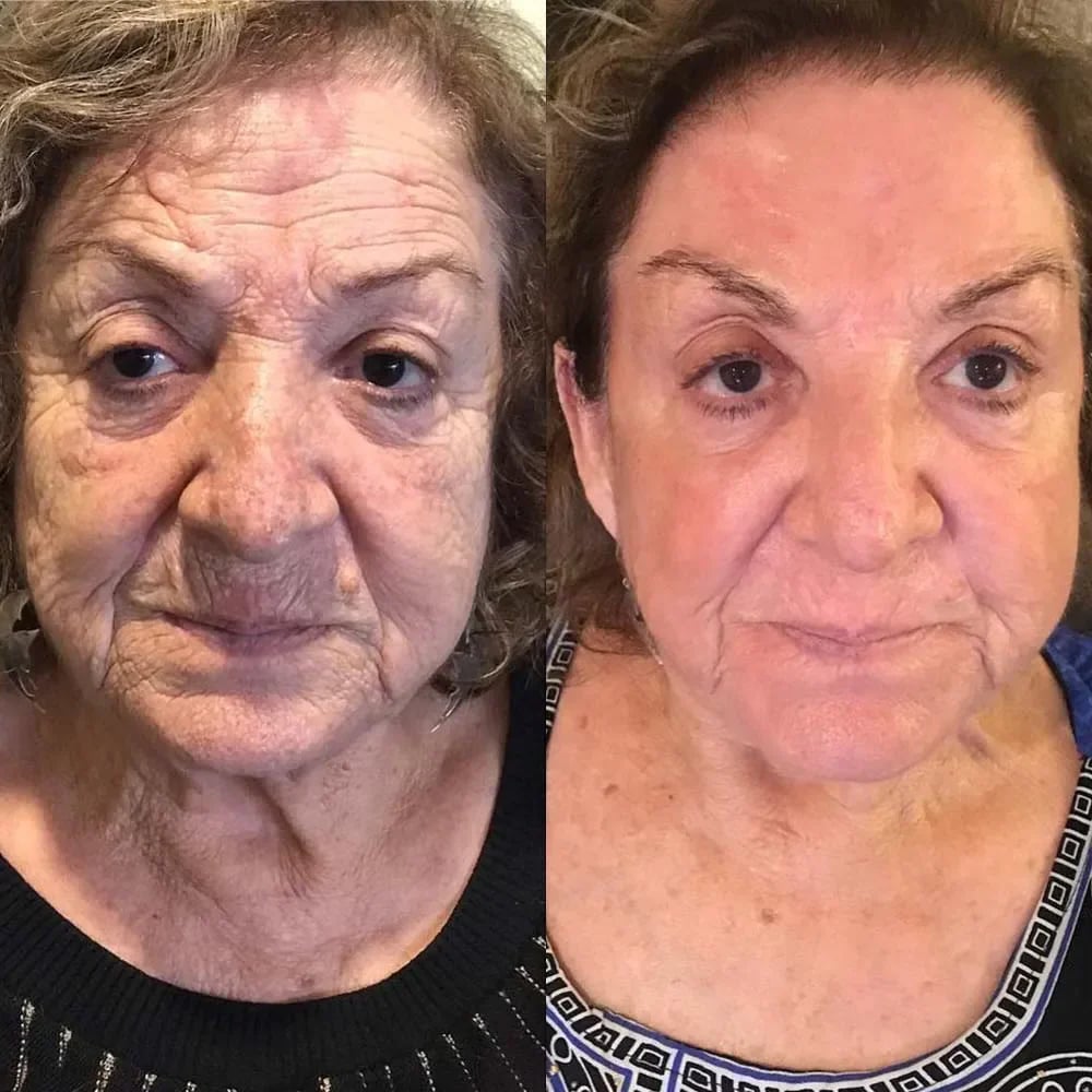BeeYouth – Botox & Bee Venom Wrinkle Cream