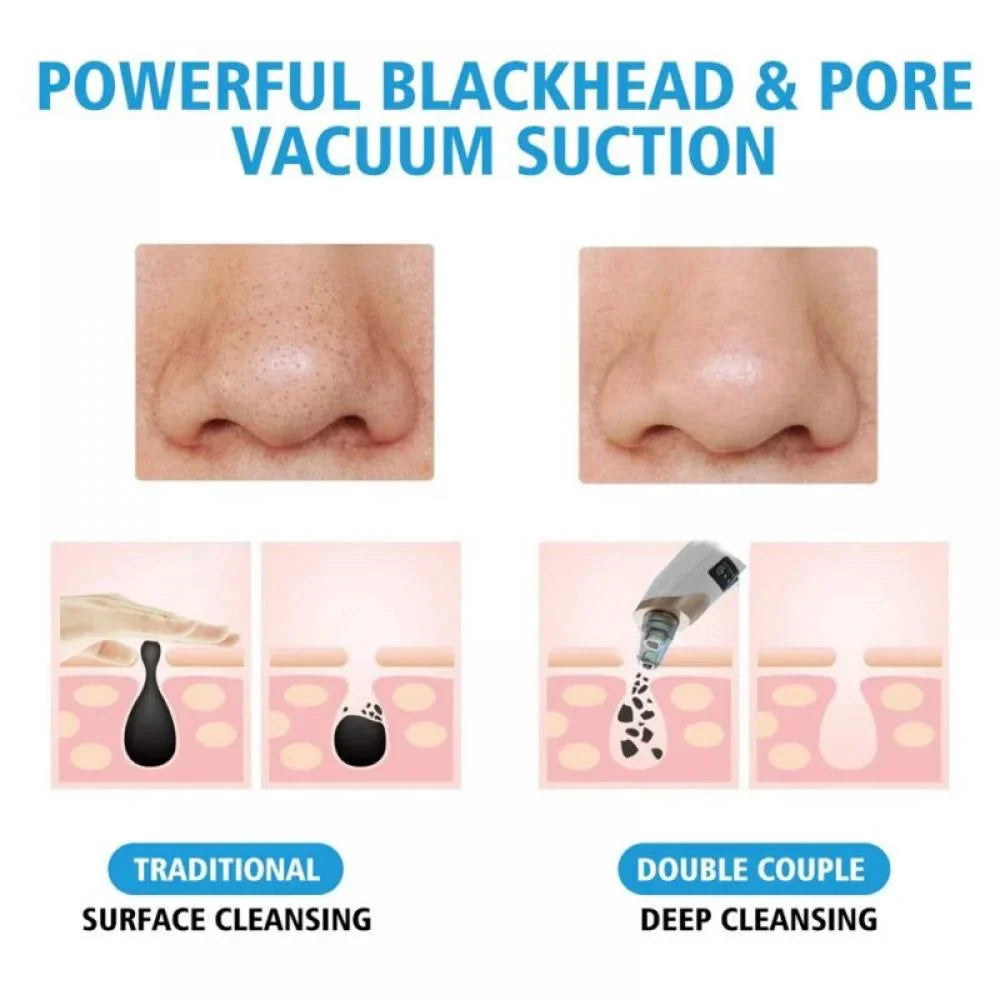 PoreCleanse – Electric Blackhead Vacuum Remover