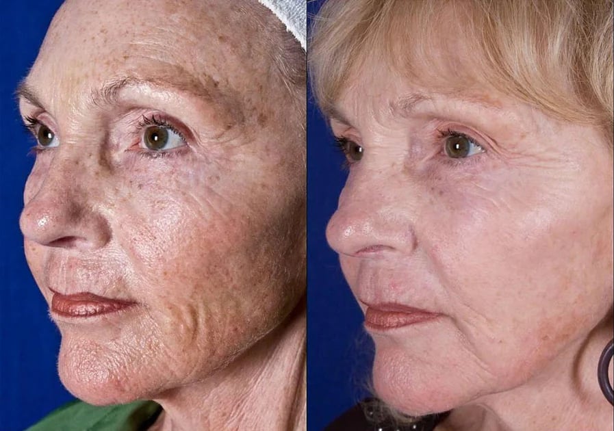 BeeYouth – Botox & Bee Venom Wrinkle Cream