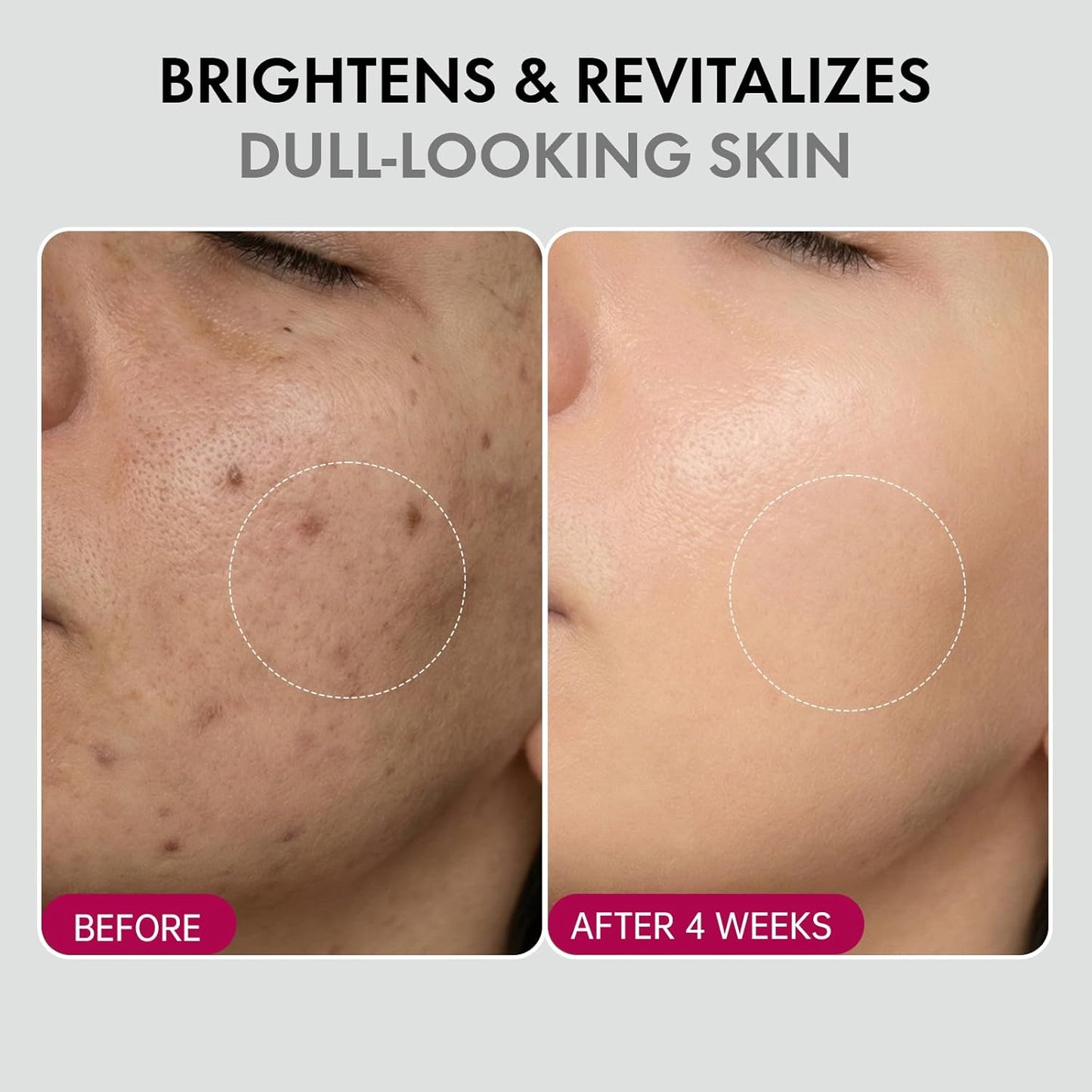 ✨ Spot Removal | Acne Treatment | Anti-Aging | Melanin Reduction | Skin Smoothing | Hydrating | Brightening & Fine Line Diminishing | Skin Renewing Cream