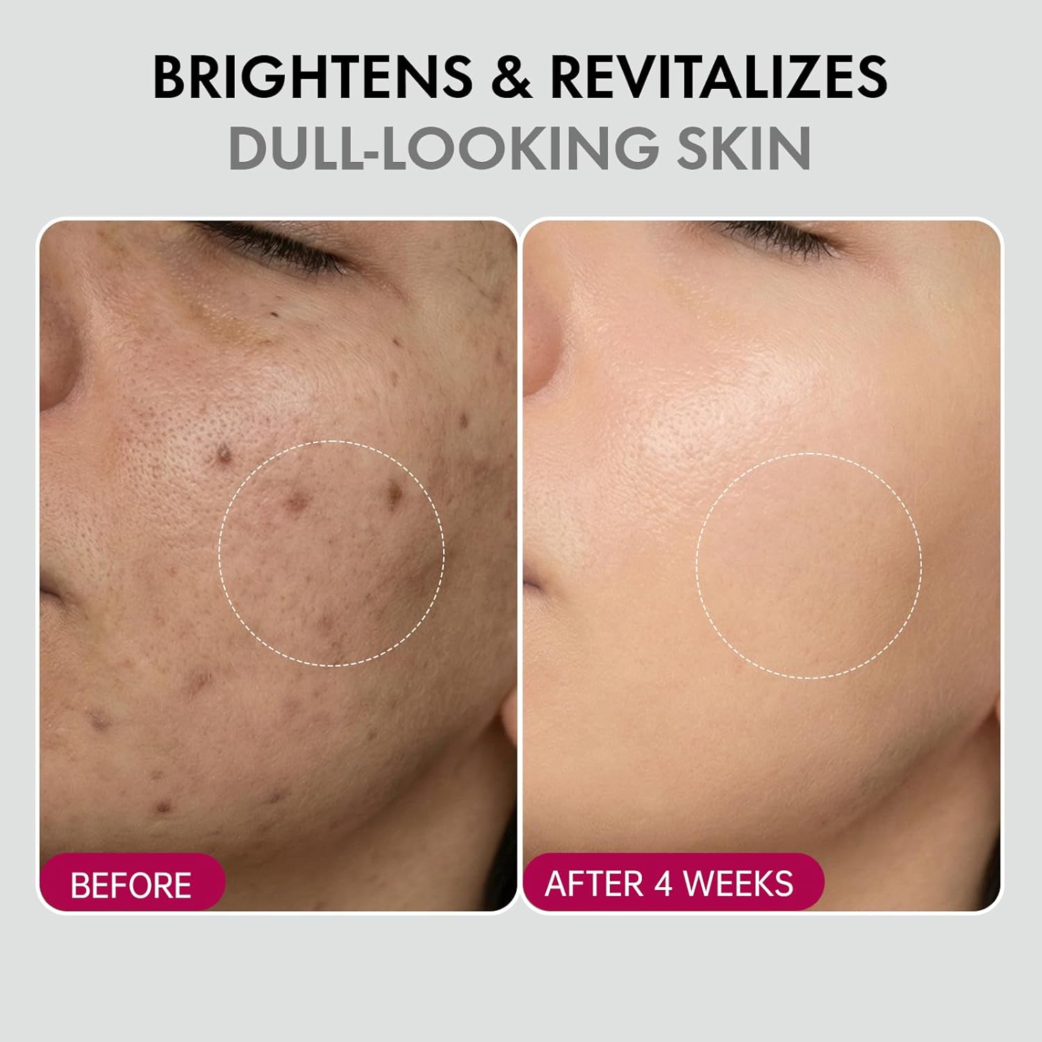 ✨ Spot Removal | Acne Treatment | Anti-Aging | Melanin Reduction | Skin Smoothing | Hydrating | Brightening & Fine Line Diminishing | Skin Renewing Cream