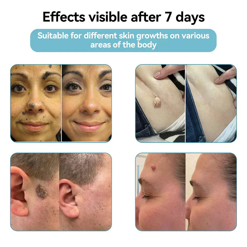 ✨VelvetSkin+™ All-in-One CO₂ Laser Eraser Pen | Removes Moles, Warts, Skin Flaws & Pigmentation