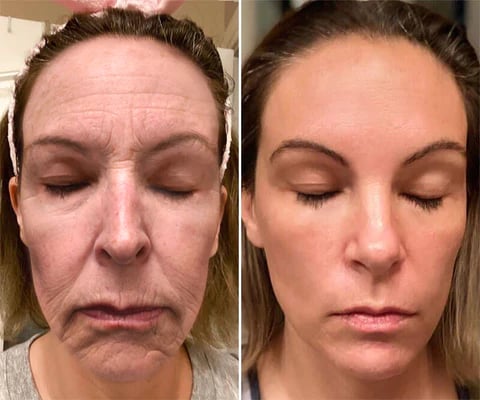 BeeYouth – Botox & Bee Venom Wrinkle Cream