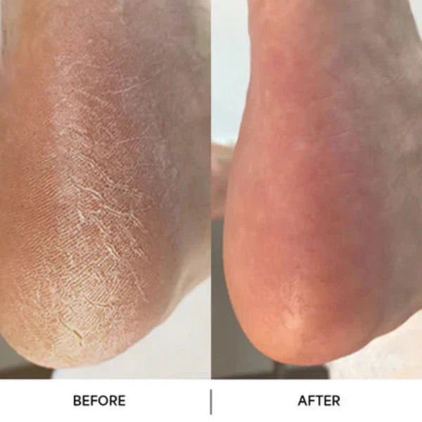 SilkStep – Professional Foot Callus Remover Tool