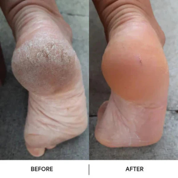 SilkStep – Professional Foot Callus Remover Tool