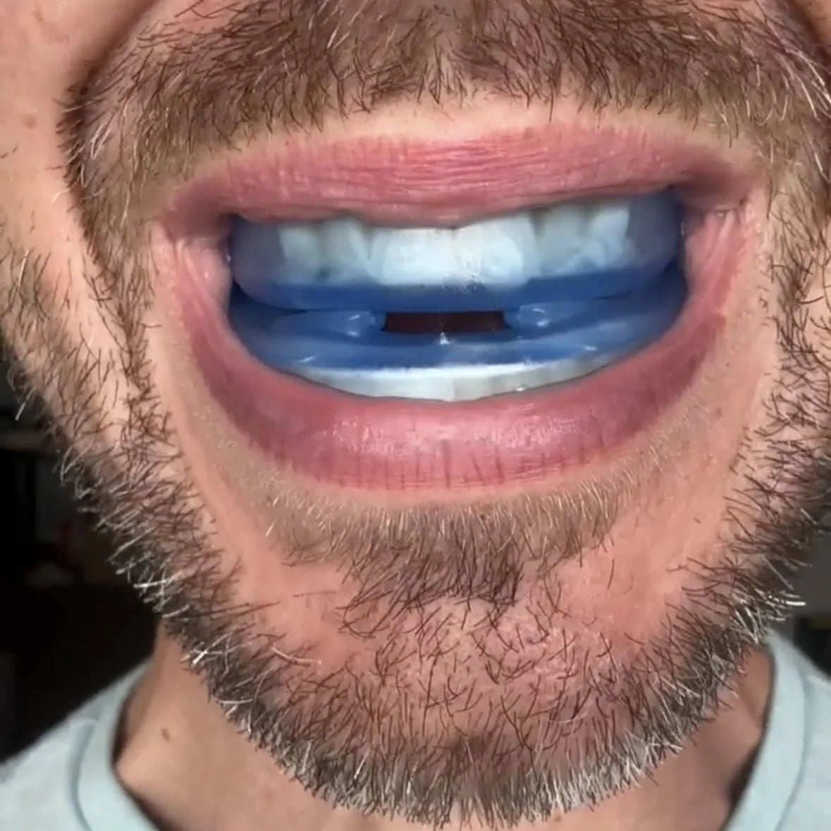 SilentGuard – Universal Anti-Snoring Mouthpiece