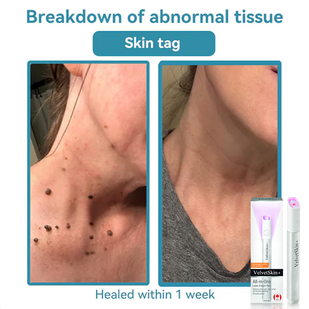 ✨VelvetSkin+™ All-in-One CO₂ Laser Eraser Pen | Removes Moles, Warts, Skin Flaws & Pigmentation