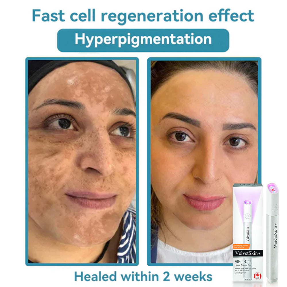✨VelvetSkin+™ All-in-One CO₂ Laser Eraser Pen | Removes Moles, Warts, Skin Flaws & Pigmentation