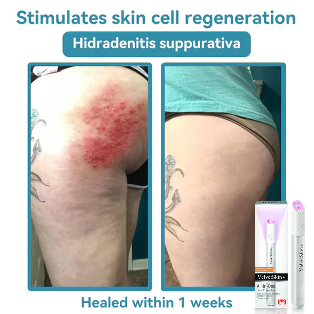 ✨VelvetSkin+™ All-in-One CO₂ Laser Eraser Pen | Removes Moles, Warts, Skin Flaws & Pigmentation