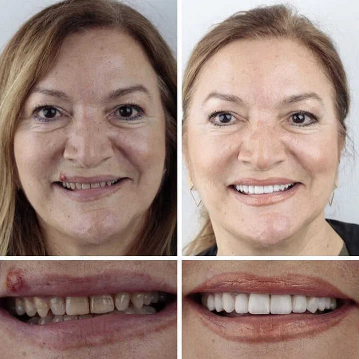 🌎Ends Today: 70% OFF! ⏰Yagoo™ Medical Full Denture with Strong Suctiond🦷Obtain American Dental Association (ADA) Certification