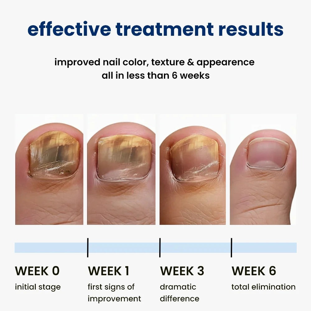 FungiGone – Night Repair Nail Patches