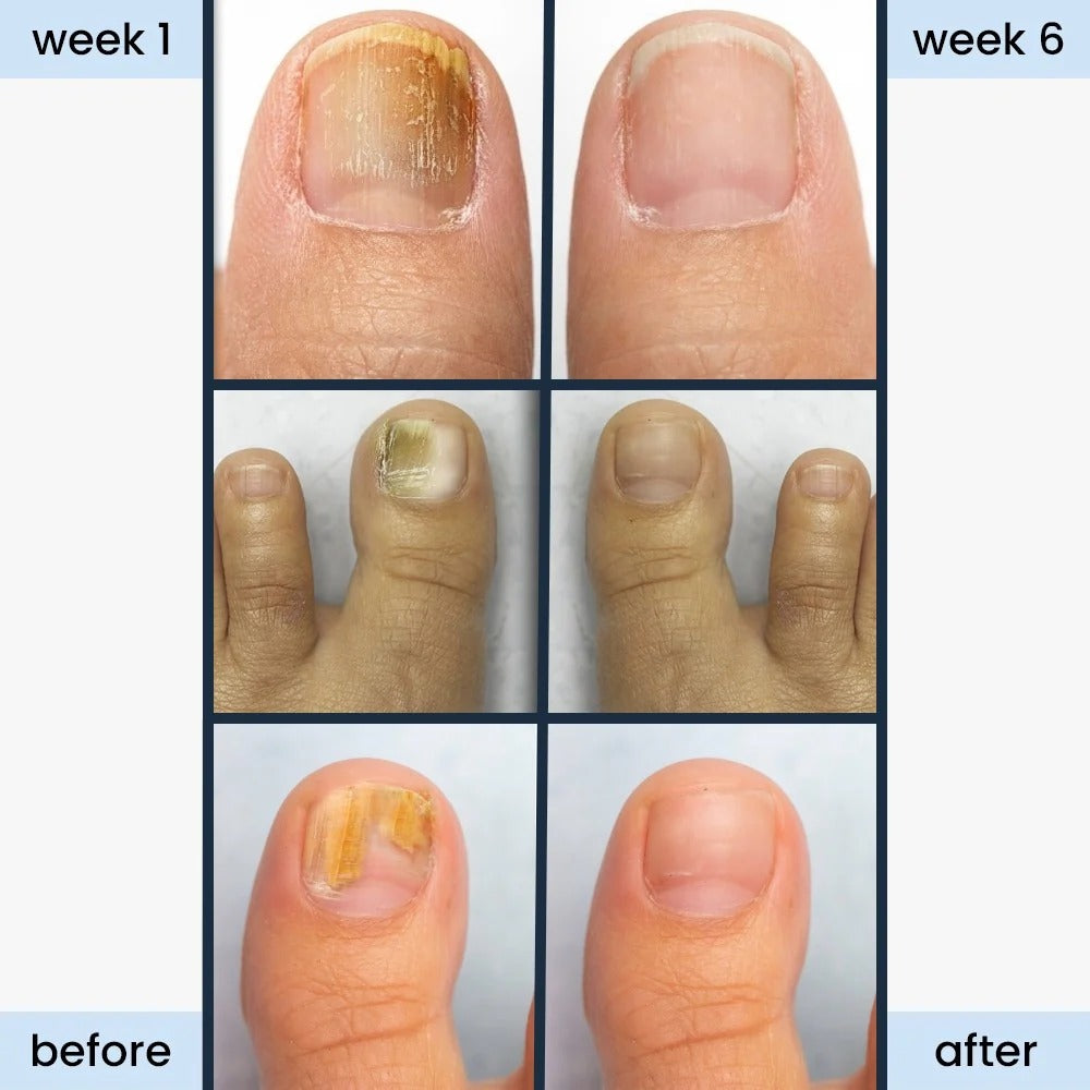 FungiGone – Night Repair Nail Patches